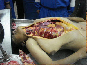 Female autopsy in Brazil. 